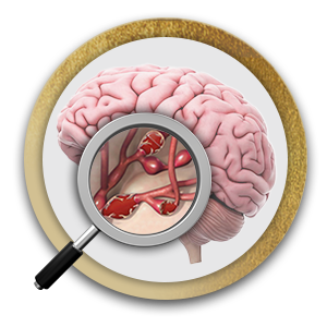 Brain Aneurysm